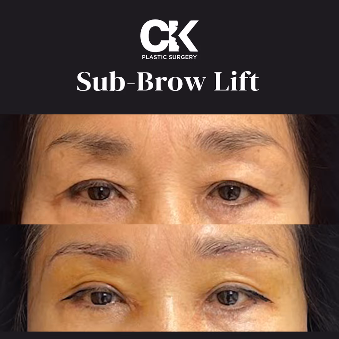 Sub Brow Excision in Los Angeles at the best plastic surgery clinic