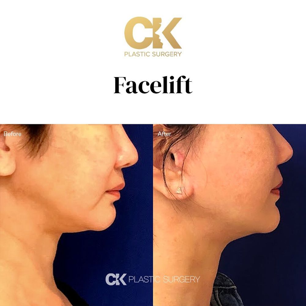 Before and after natural facelift for a youthful, refreshed appearance in Los Angeles