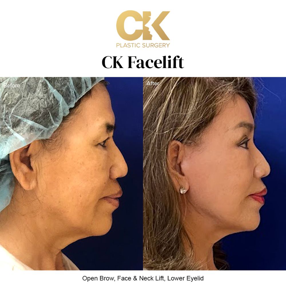 Before and after natural facelift for a youthful, refreshed appearance in Los Angeles