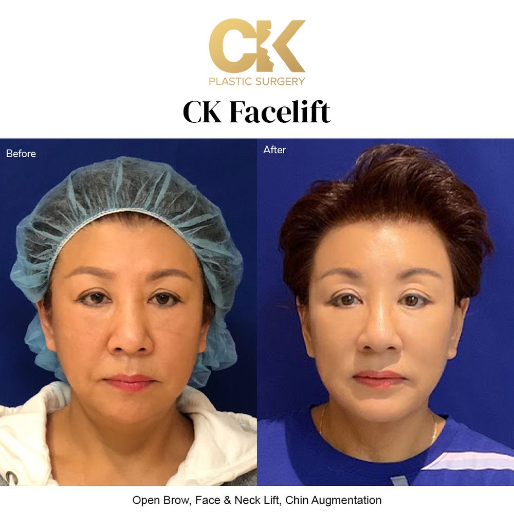 Before and after natural facelift for a youthful, refreshed appearance in Los Angeles