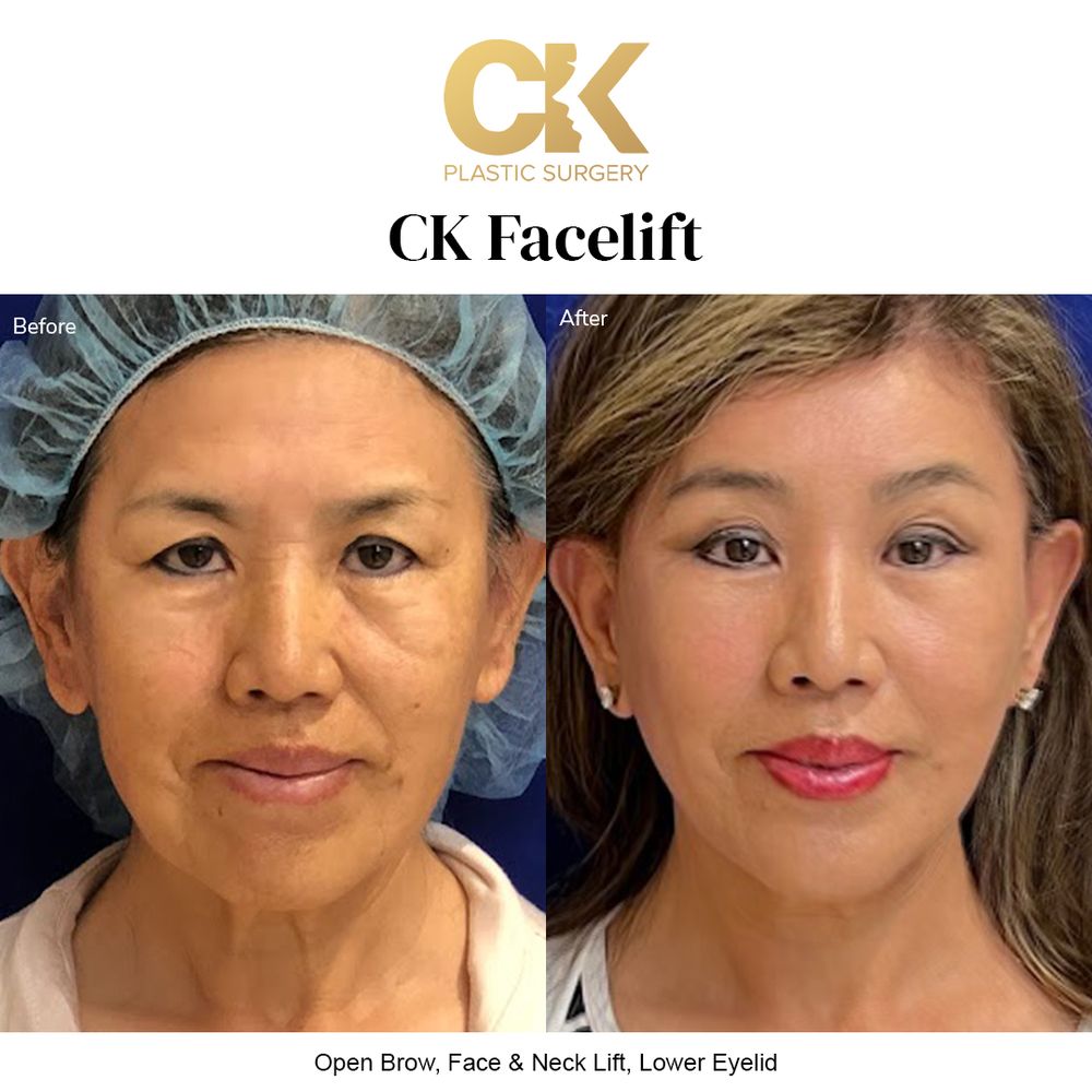 Before and after natural facelift for a youthful, refreshed appearance in Los Angeles