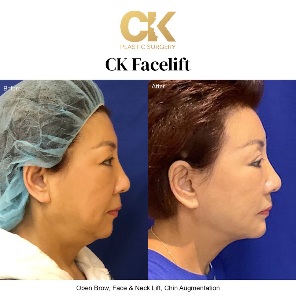 Before and after natural facelift for a youthful, refreshed appearance in Los Angeles