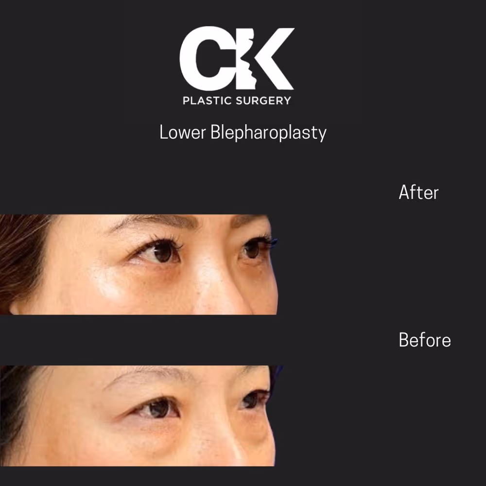 Lower Blepharoplasty Los Angeles CK Plastic Surgery Paitent Before and After picture. 