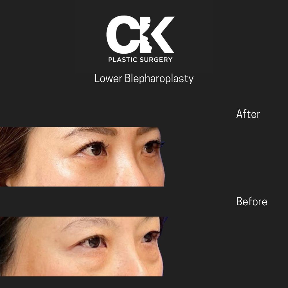 Lower Blepharoplasty Los Angeles CK Plastic Surgery Paitent Before and After picture. 