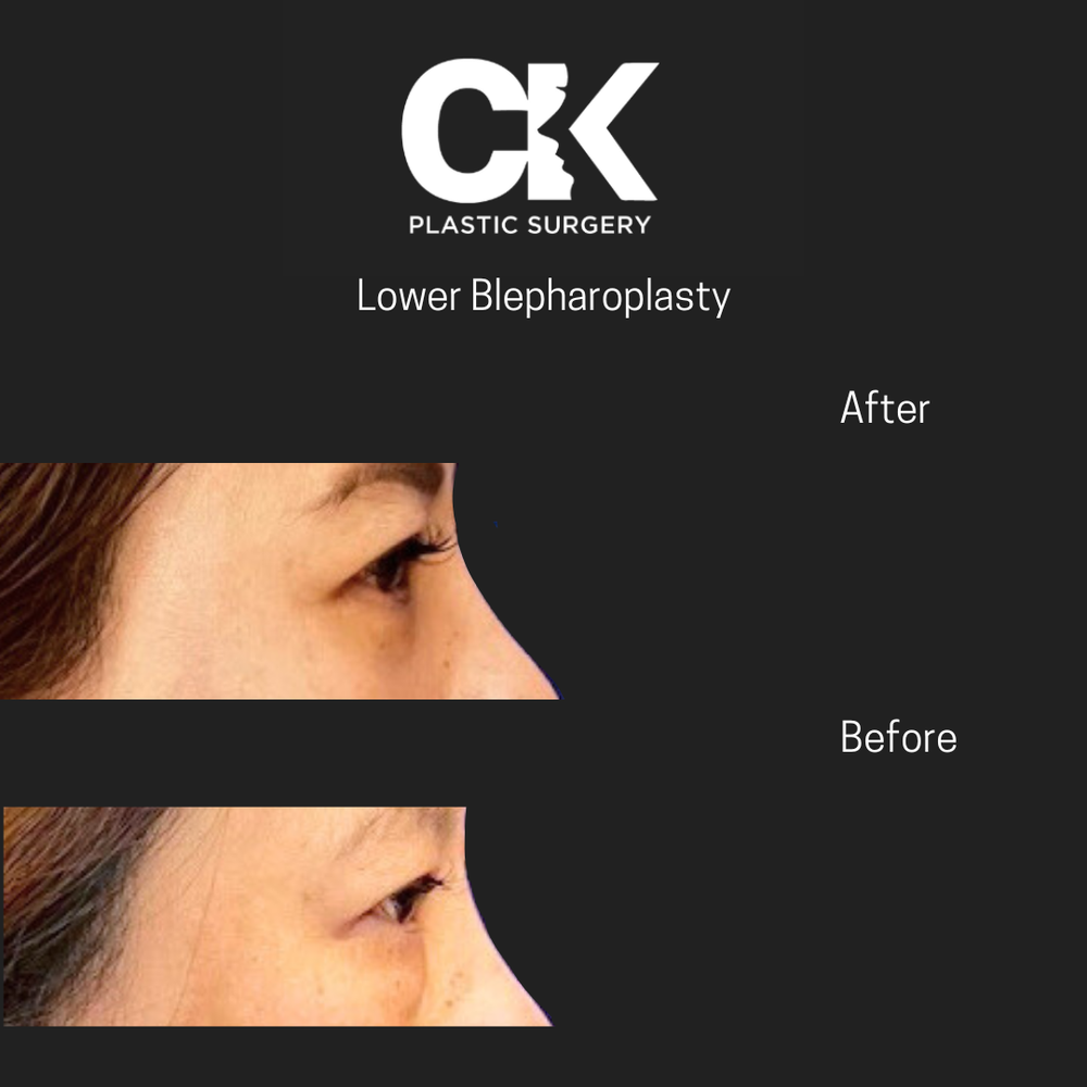 Lower Blepharoplasty Los Angeles CK Plastic Surgery Paitent Before and After picture. 