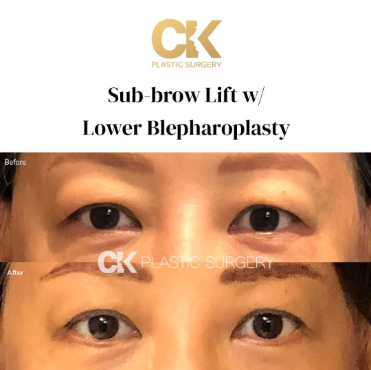 Lower Blepharoplasty Los Angeles CK Plastic Surgery Paitent Before and After picture. 