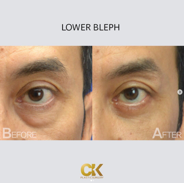 Lower Blepharoplasty Patient pictures. Los Angeles Male. Plastic Surgery for men. 
