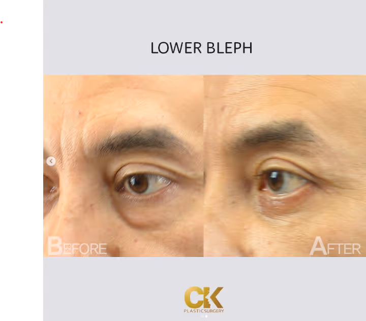 Los Angeles plastic surgery for men. Blepharoplasty before and after images K Plastic Surgery Korean