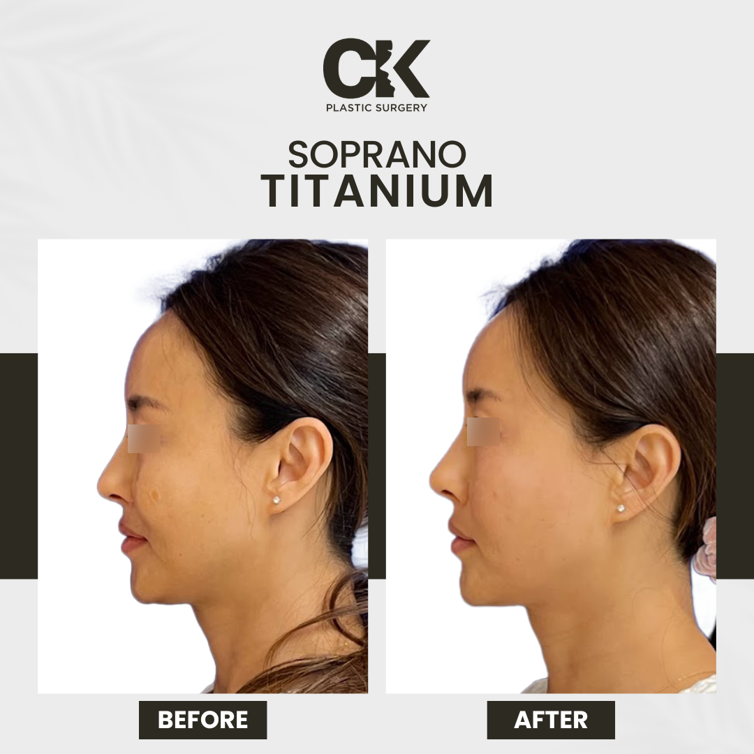 Before and after photo of a patient receiving a non-surgical titanium lifting treatment at a Los Angeles clinic.