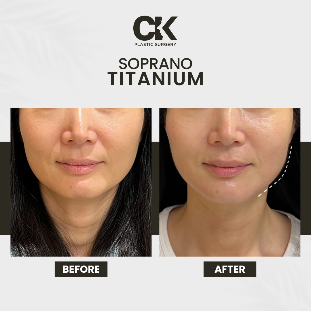 Aesthetician performing titanium lifting laser treatment on a client's jawline at a beauty clinic in Los Angeles, California.