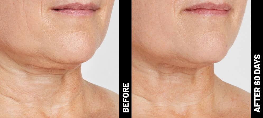 A side-by-side comparison of a client's face before and three months after their Ultherapy treatment, revealing a more defined jawline