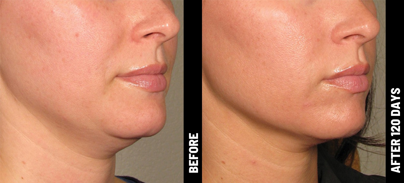 A side-by-side comparison of a client's face before and three months after their Ultherapy treatment, revealing a more defined jawline