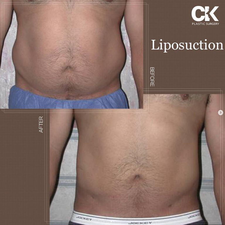 Liposuction before and after male southern california at plastic surgery in korea town