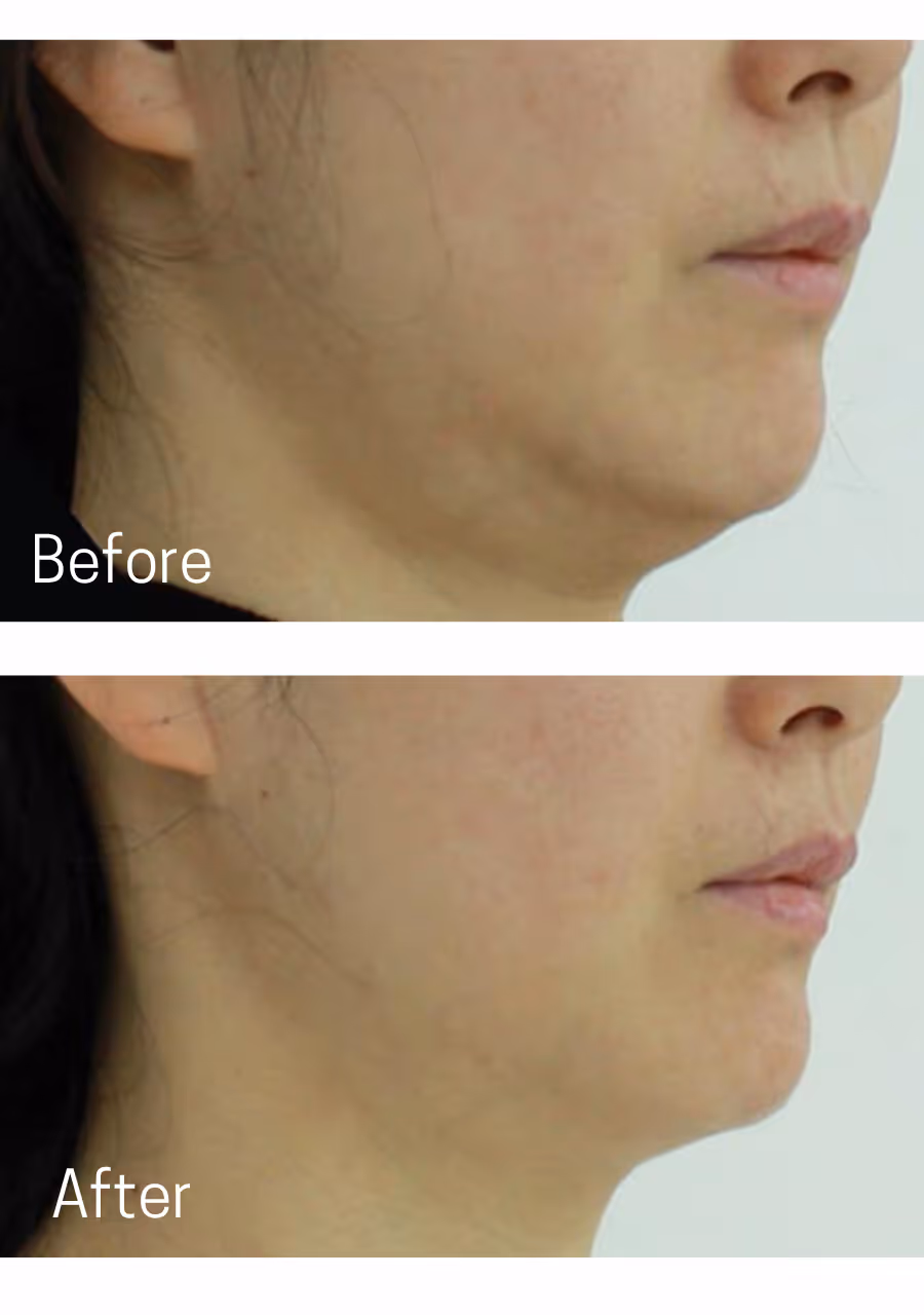 Oligio Before and After, CK Plastic Surgery by Dr Charles Kim