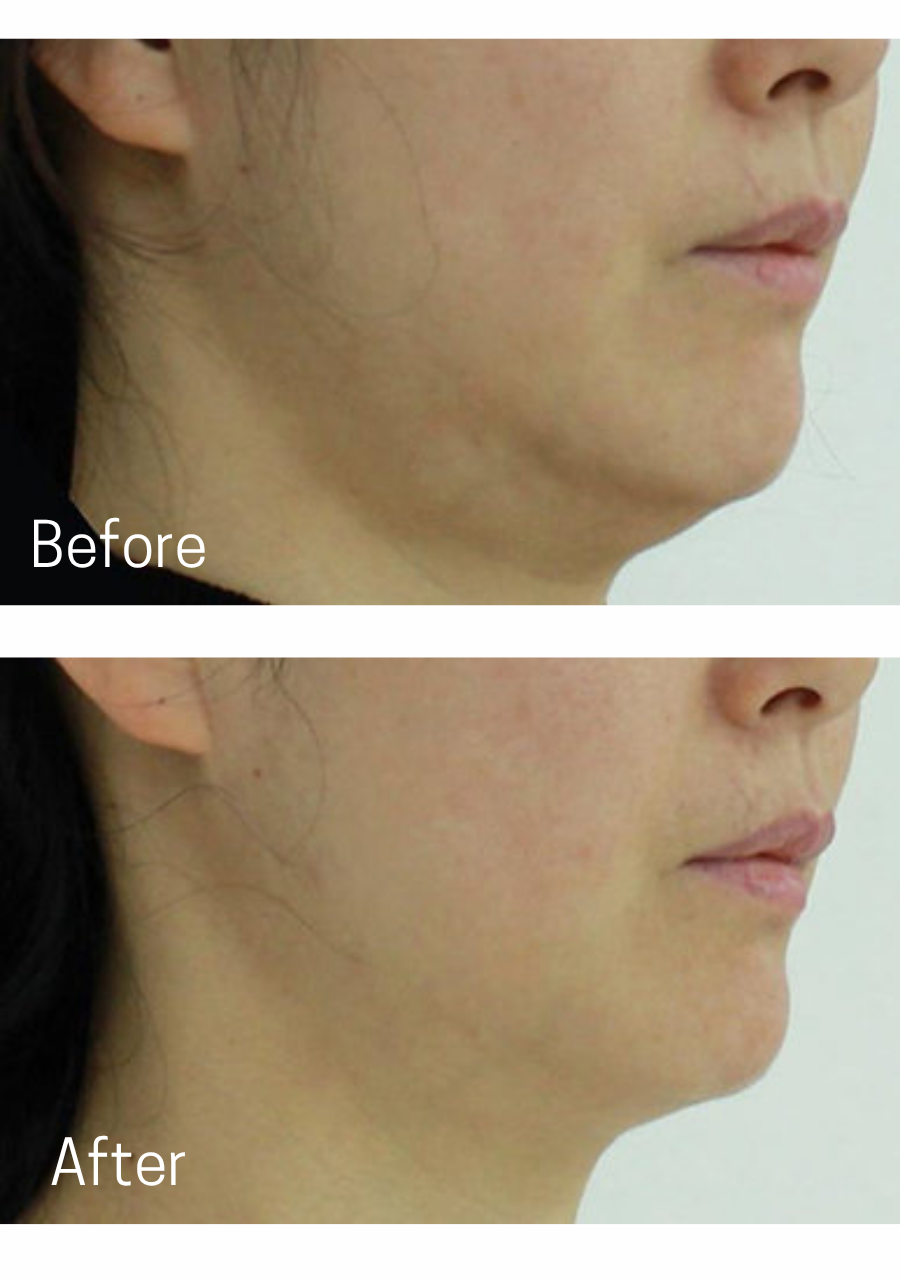 Oligio Before and After, CK Plastic Surgery by Dr Charles Kim