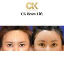 Korean Plastic Surgery Brow Lift Results Real Patient