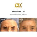 Openbrow Lift Korean Plastic Surgery in Korea Town Pictures of patients