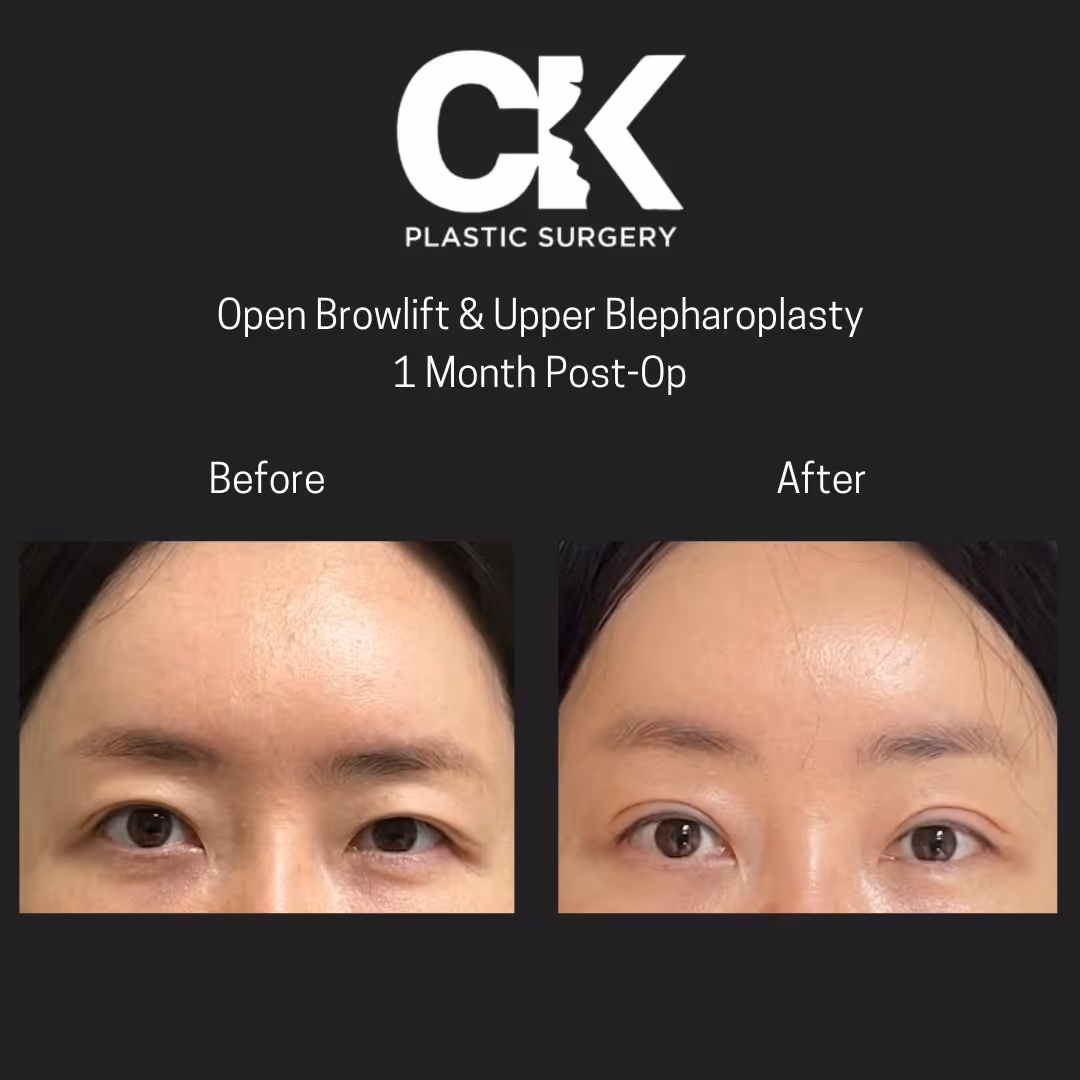 Open Browlift and Upper Blepharoplasty at korean plastic surgery clinic done by doctor charles kim