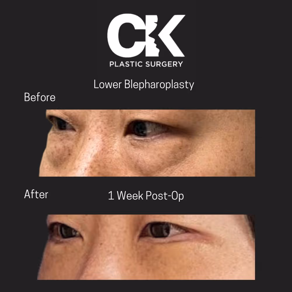 Lower Blepharoplasty procedure in Los Angeles at a Korean Plastic Surgery Clinic