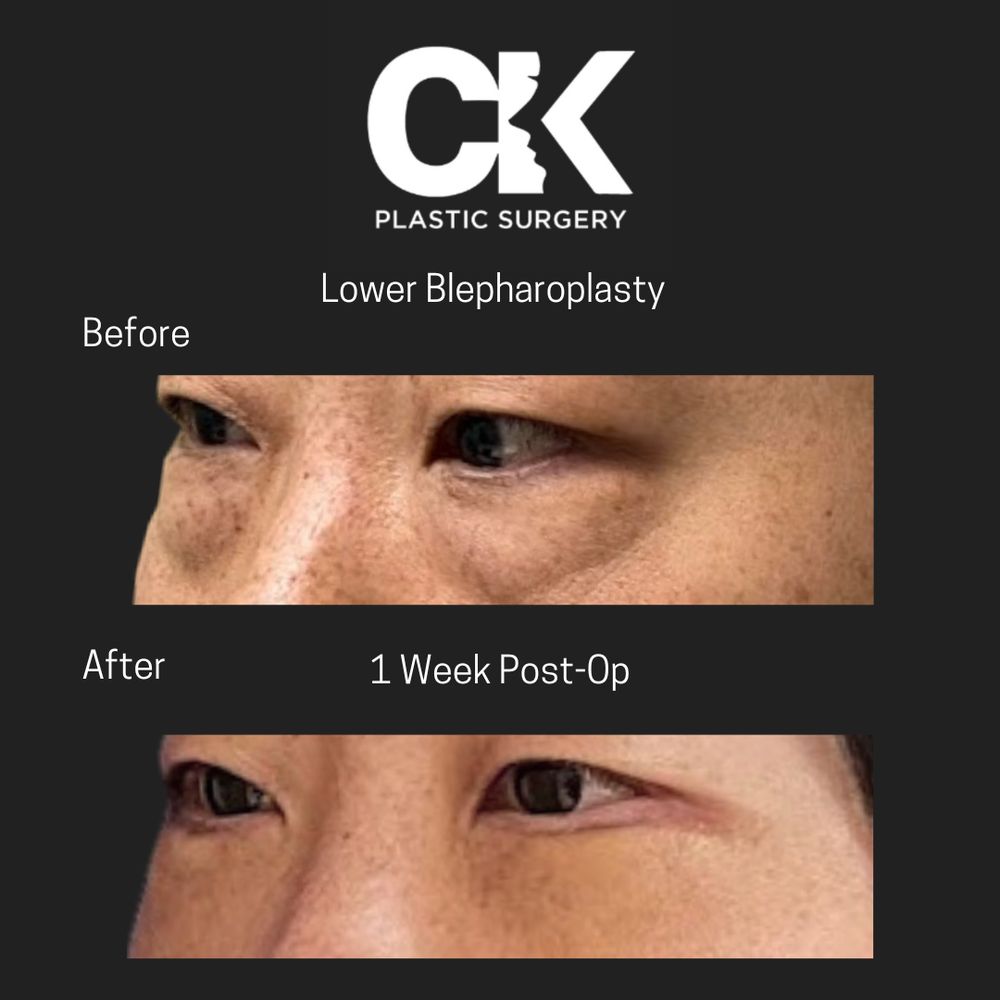 Lower Blepharoplasty procedure in Los Angeles at a Korean Plastic Surgery Clinic