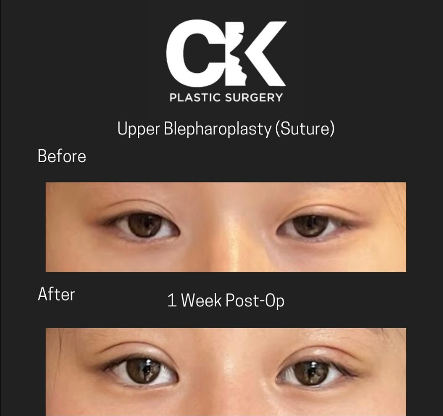 Asian Eyelid Procedure with Dr. Charles Kim