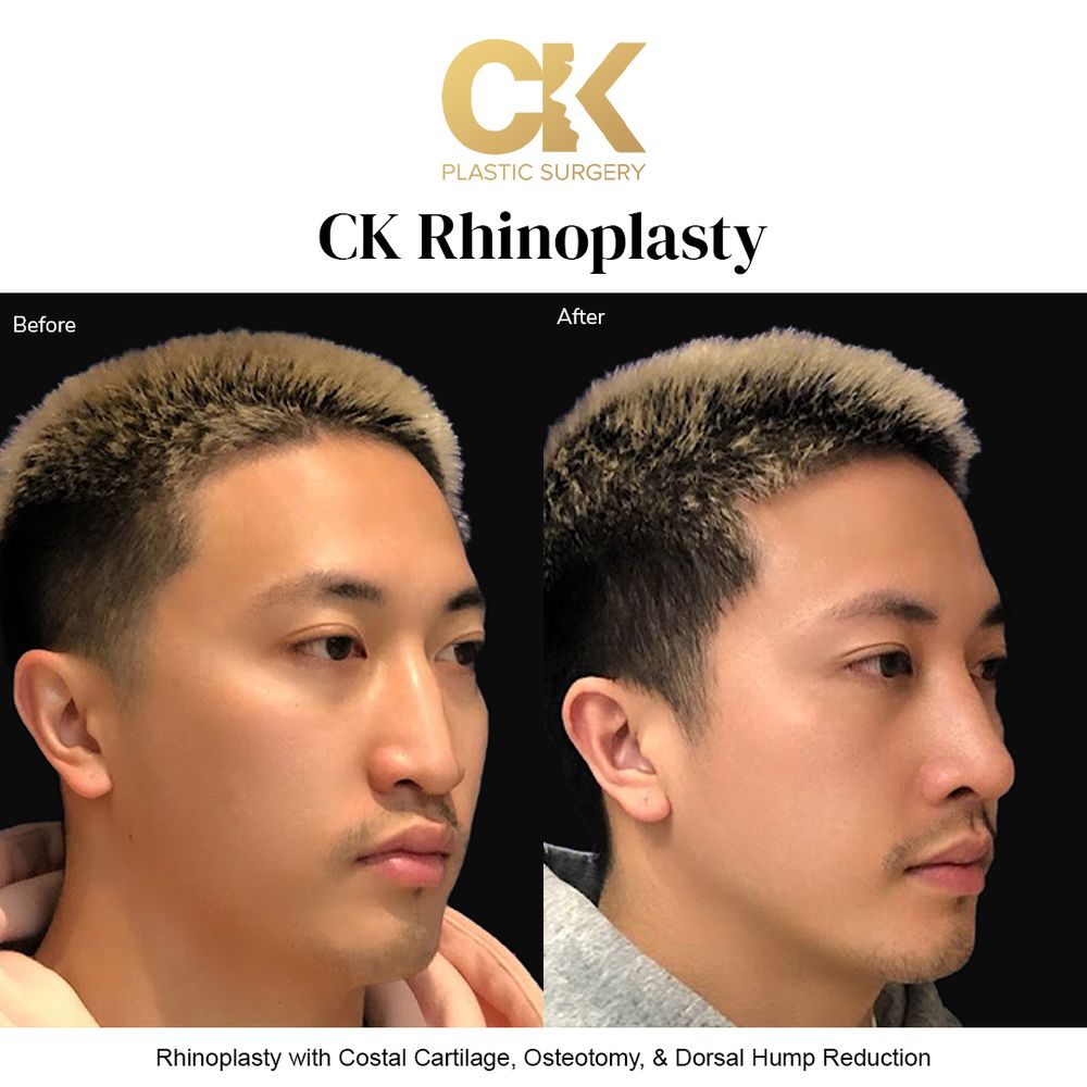 Patient review and video of his Asian Rhinoplasty journey with Dr. Kim