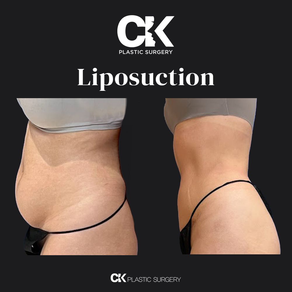 A patient of Dr. Kims who has the liposuction body contouring procedure at Asian plastic surgery clinic in LA