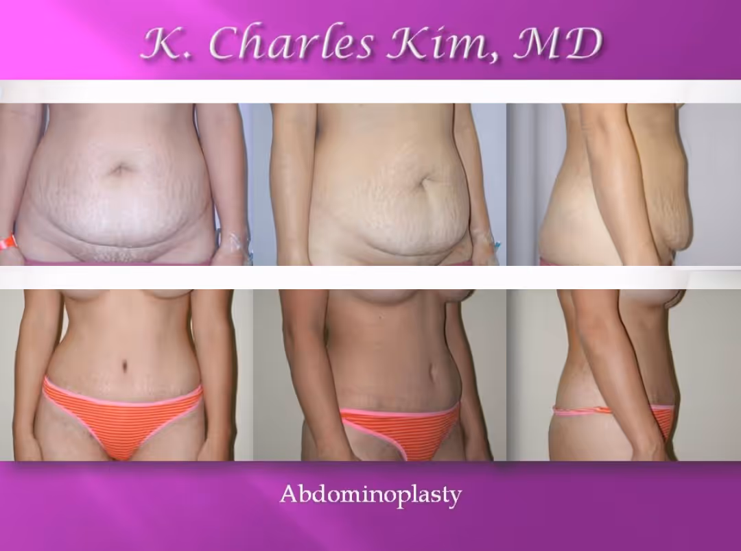 Patient who recieved the abdominoplasty procedure by Dr. Kim in Korea Town Los Angeles at Asian Plastic Surgery clinic