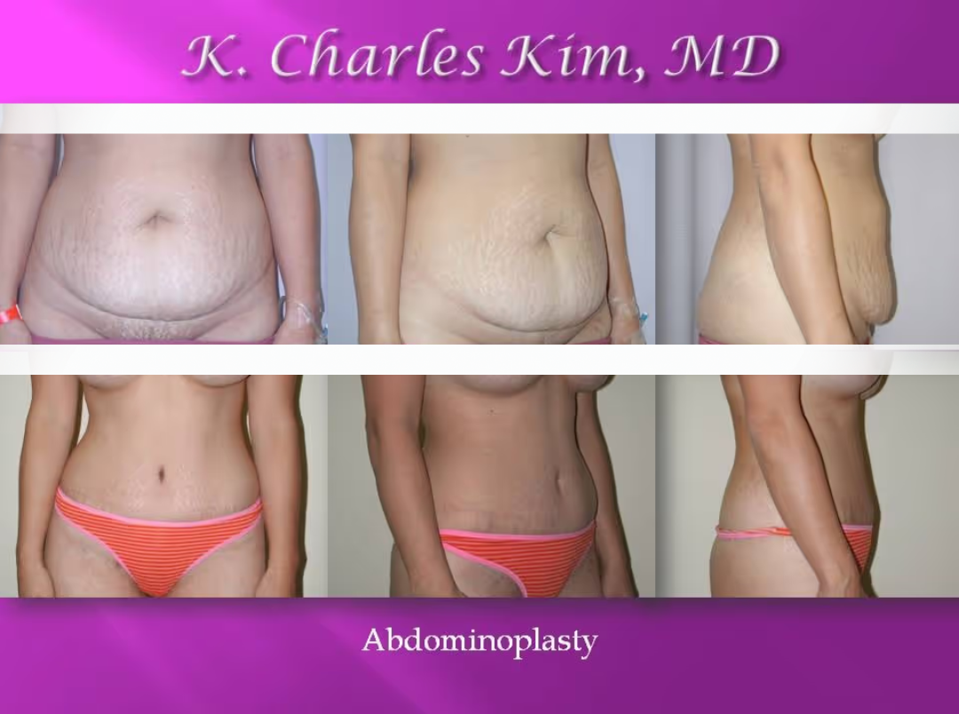 Patient who recieved the abdominoplasty procedure by Dr. Kim in Korea Town Los Angeles at Asian Plastic Surgery clinic