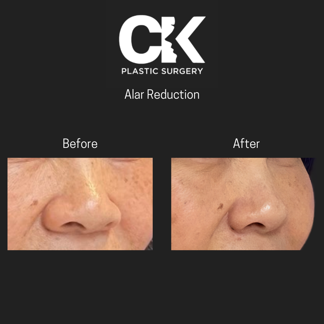 ck plastic surgery before and after alar reduction