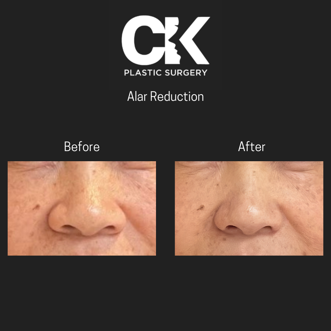 ck plastic surgery before and after alar reduction