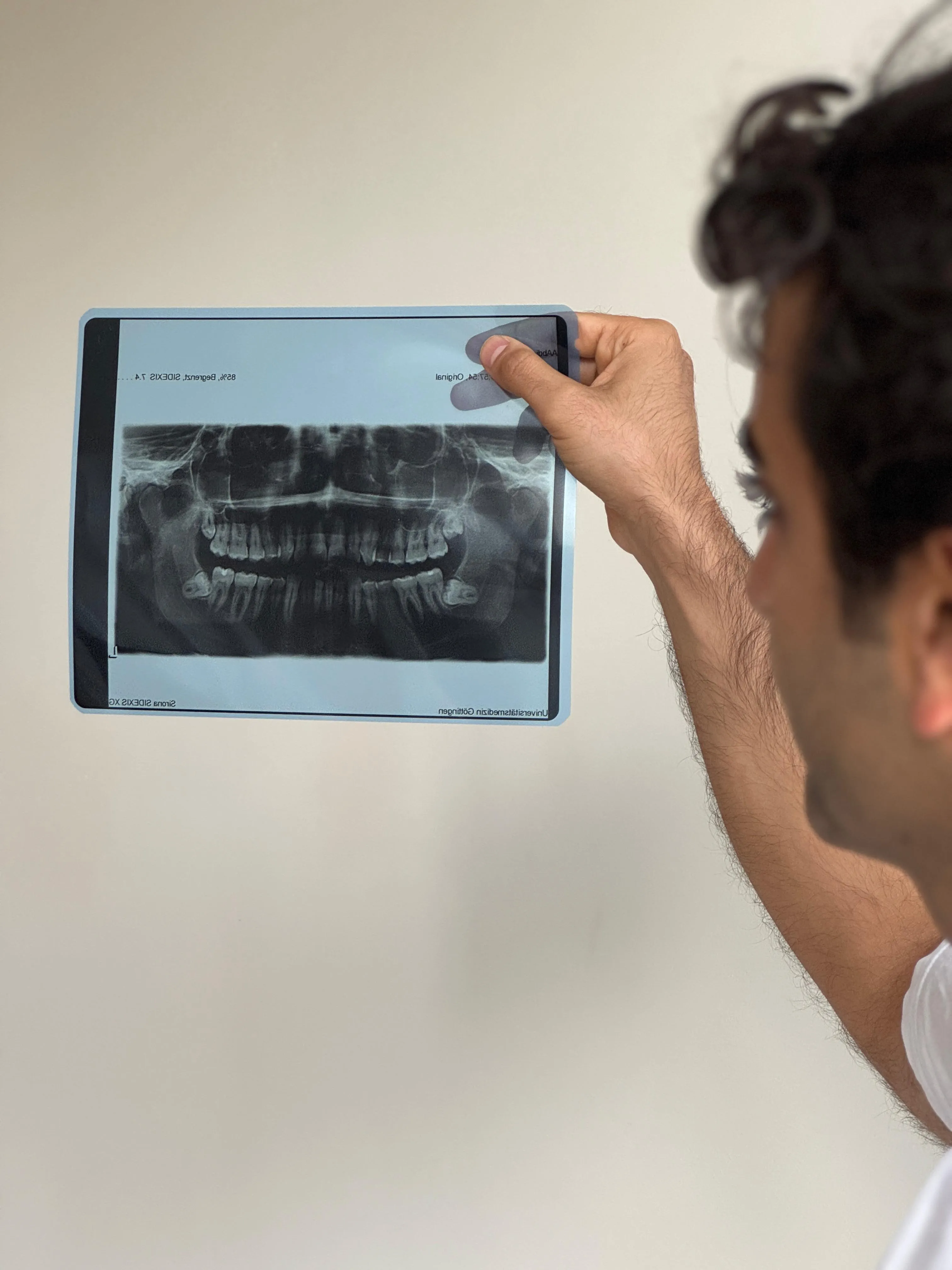 Entfernung eines Weisheitszahns in der Klinik Pinnau unter Aufsicht eines erfahrenen Chirurgen