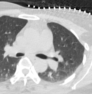 CT image Pulmonary nodule before MWA