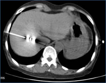 CT image of liver during MWA