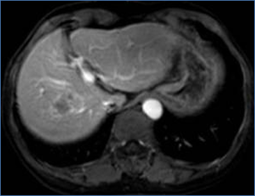 CT image of liver before treatment