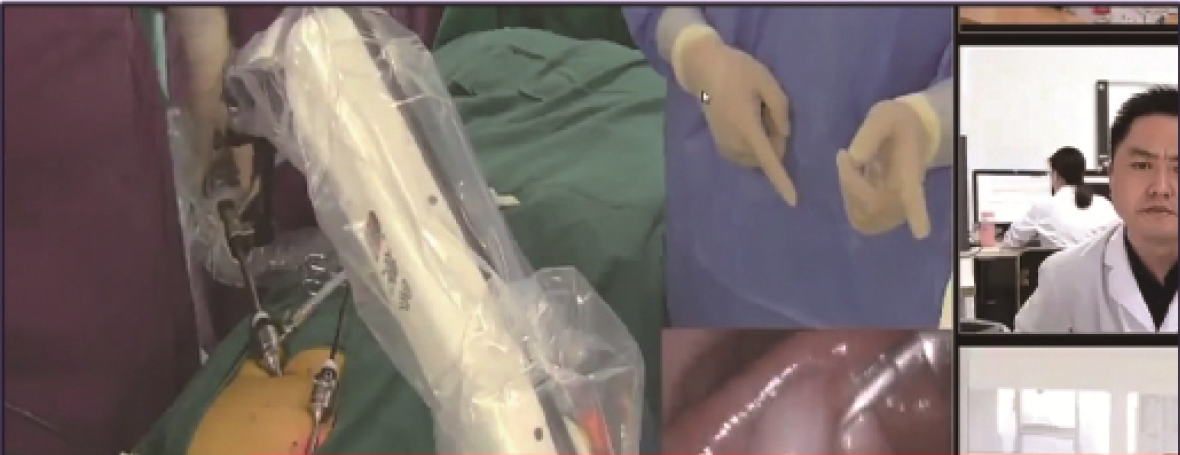 Remote surgical ablation for laparoscopy device