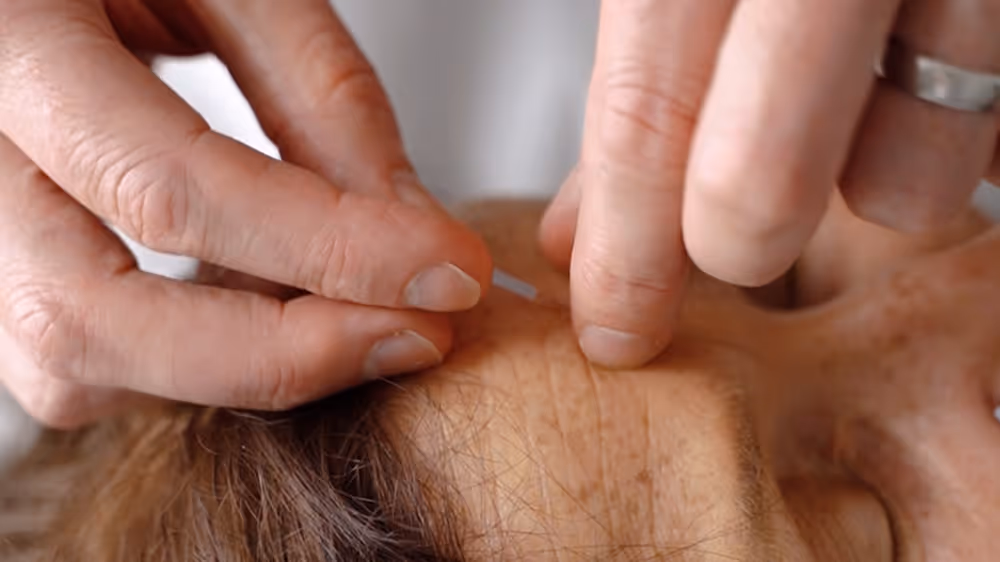 Acupuncture on women's forehead
