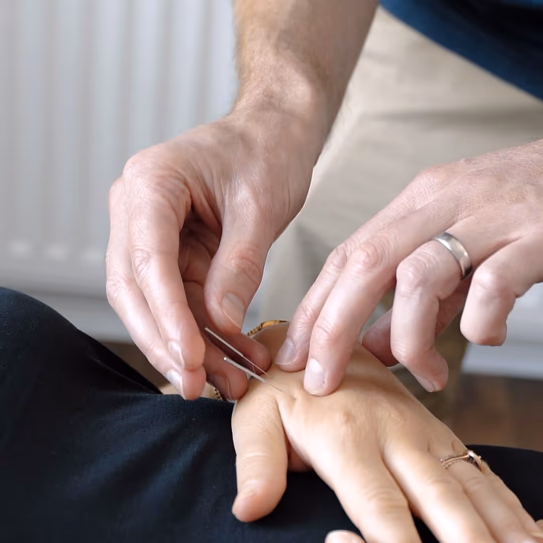 Paul performing acupuncture on a hand