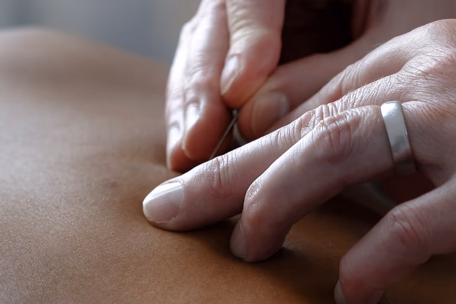 Hands performing acucpuncture