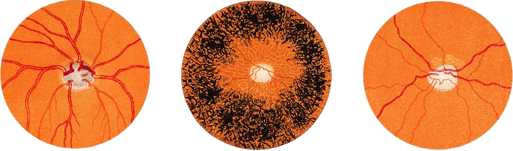 Images of the back of an eye from an eye exam