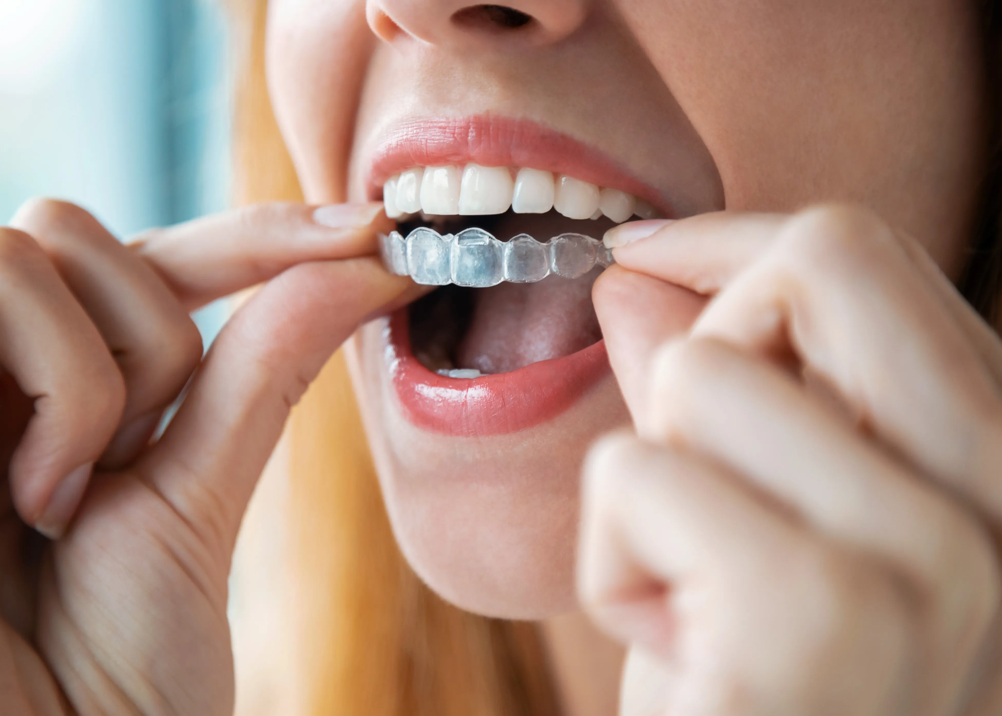 A woman putting on a Clear Aligners to her teeth.