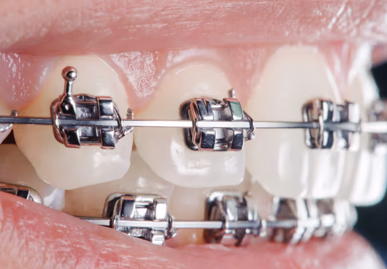Braces