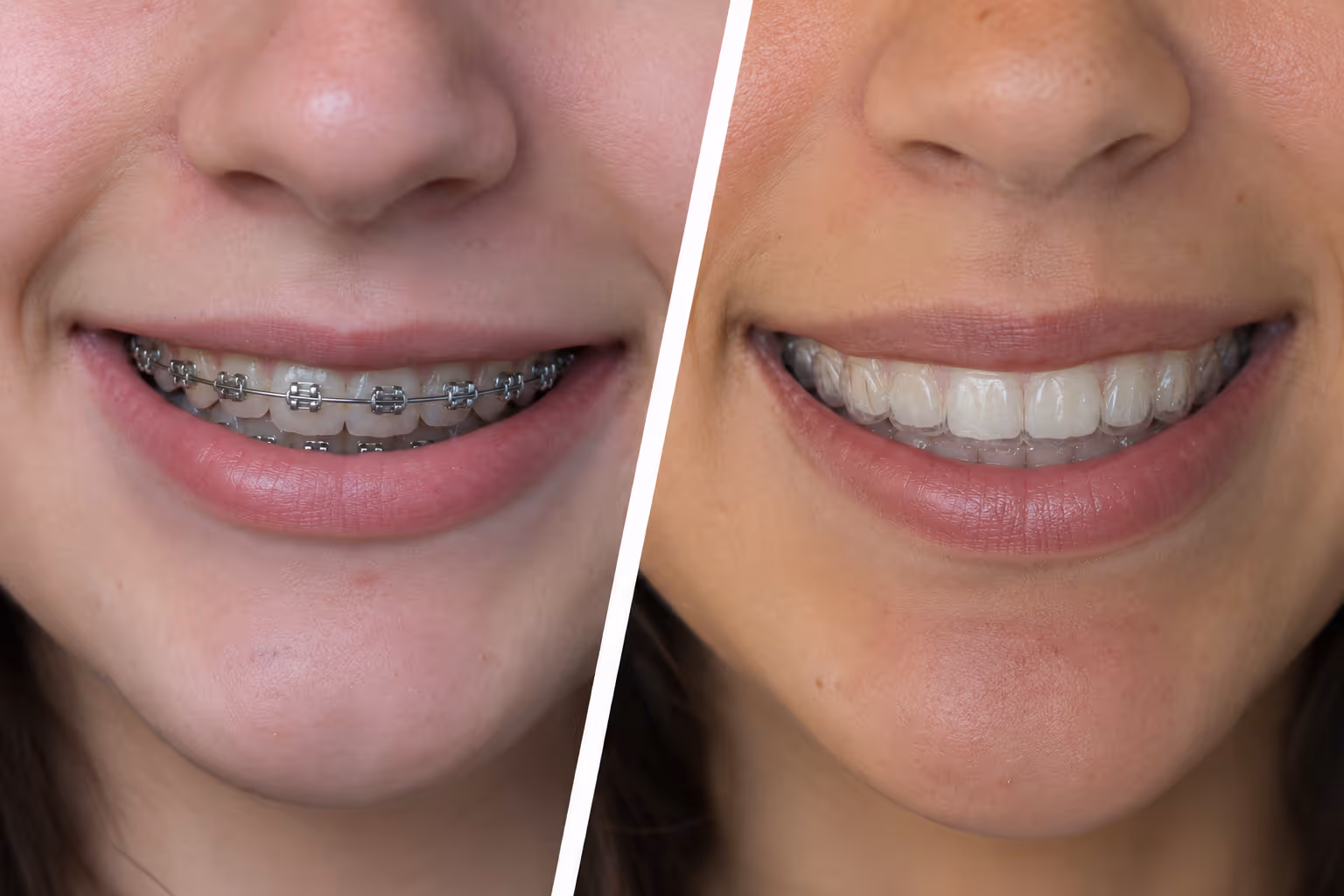 Braces and Invisalign