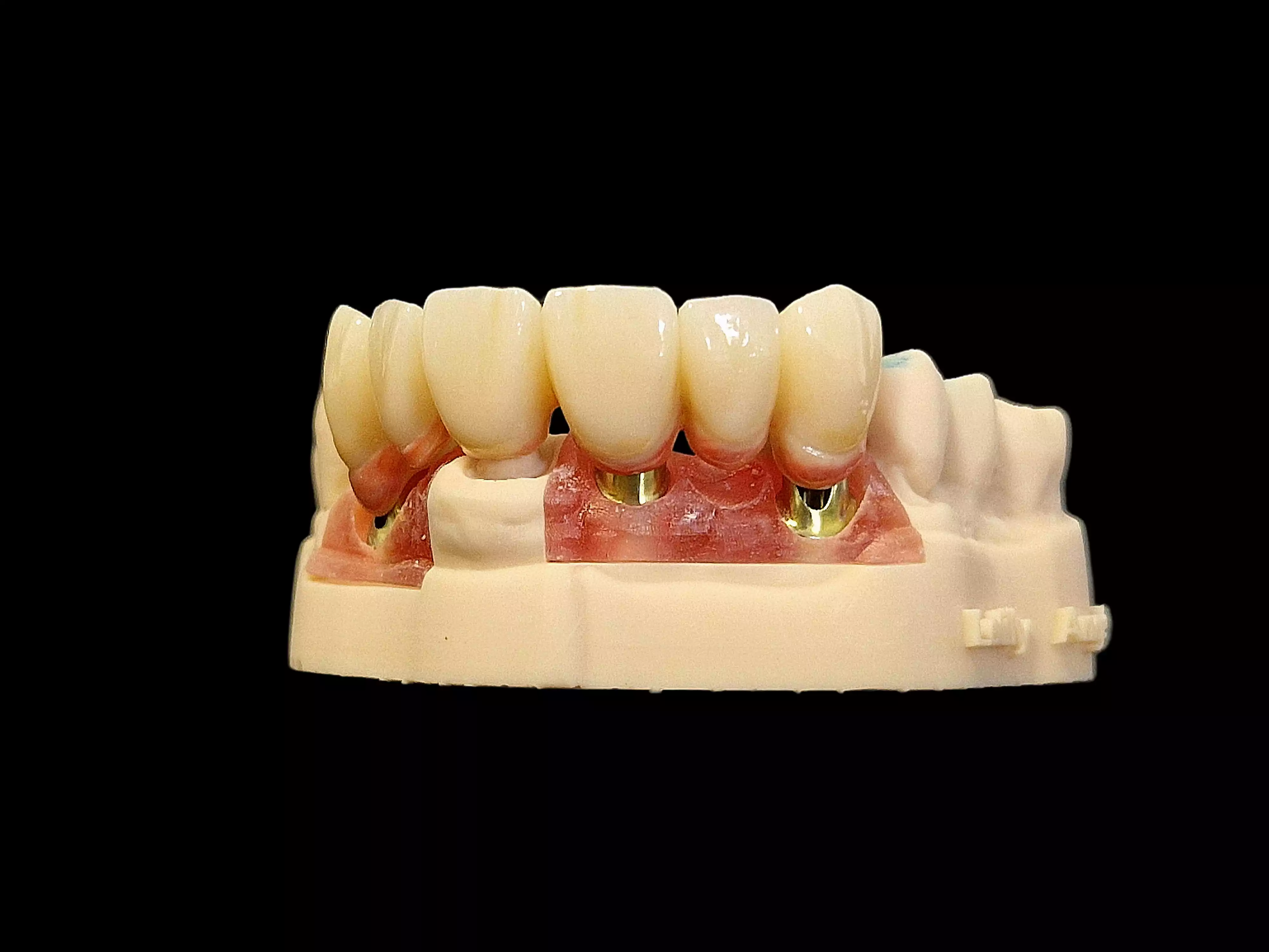 Bridge zircone réalisé par le laboratoire MDSolution