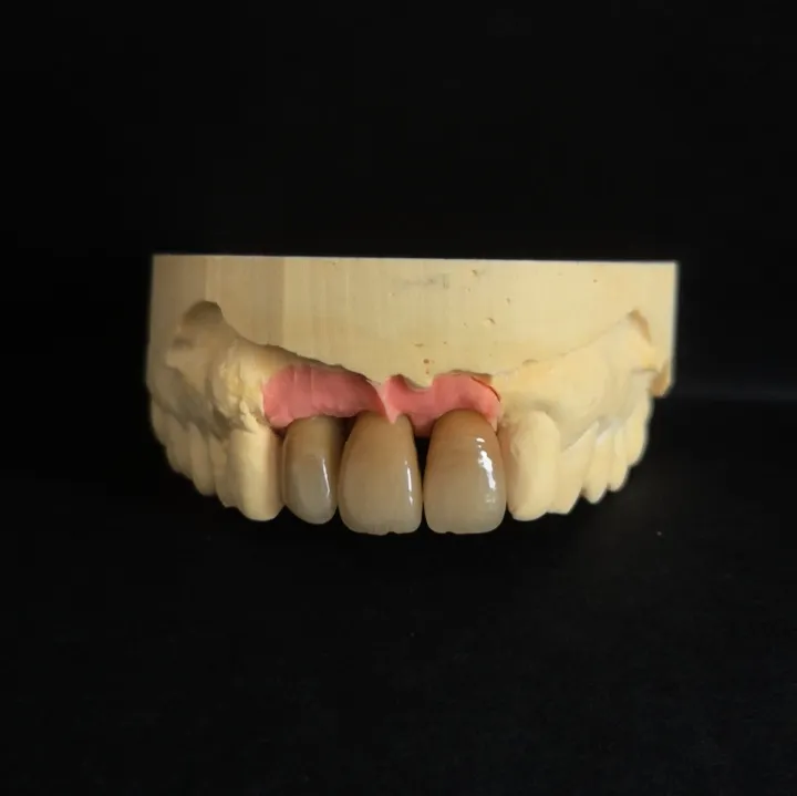 Couronnes Transvisées céramique sur zircone réalisé par le laboratoire MDSolution