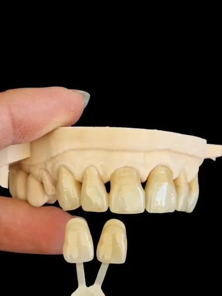 Couronnes Zircone micro stratifiées réalisé par le laboratoire MDSolution
