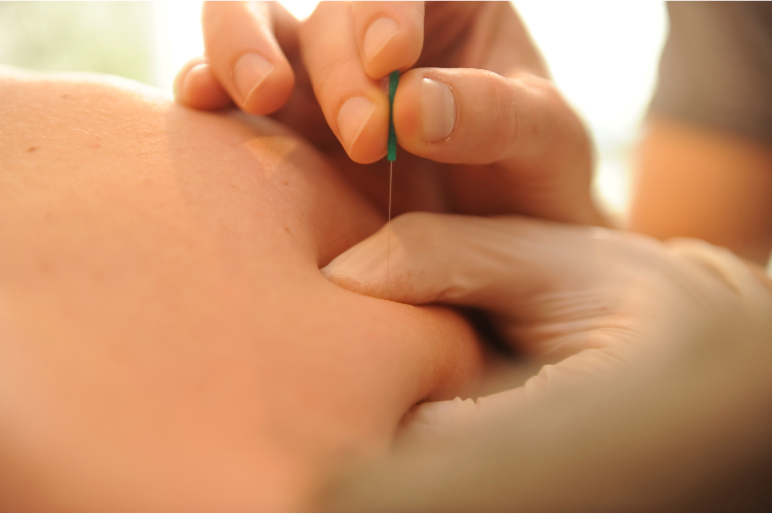 Dry needling