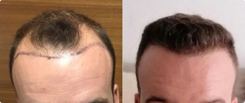 hair-transplant
