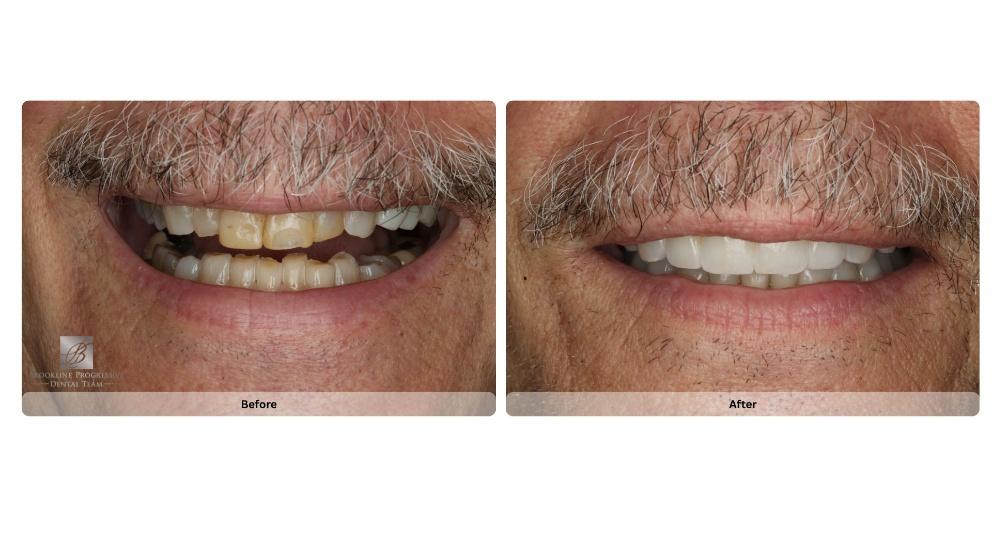 Close-up of a person's teeth