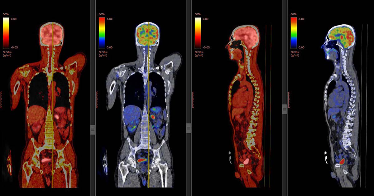 PET Scan y Cáncer: Cómo Funciona y Por Qué es Clave en tu Diagnóstico y Tratamiento